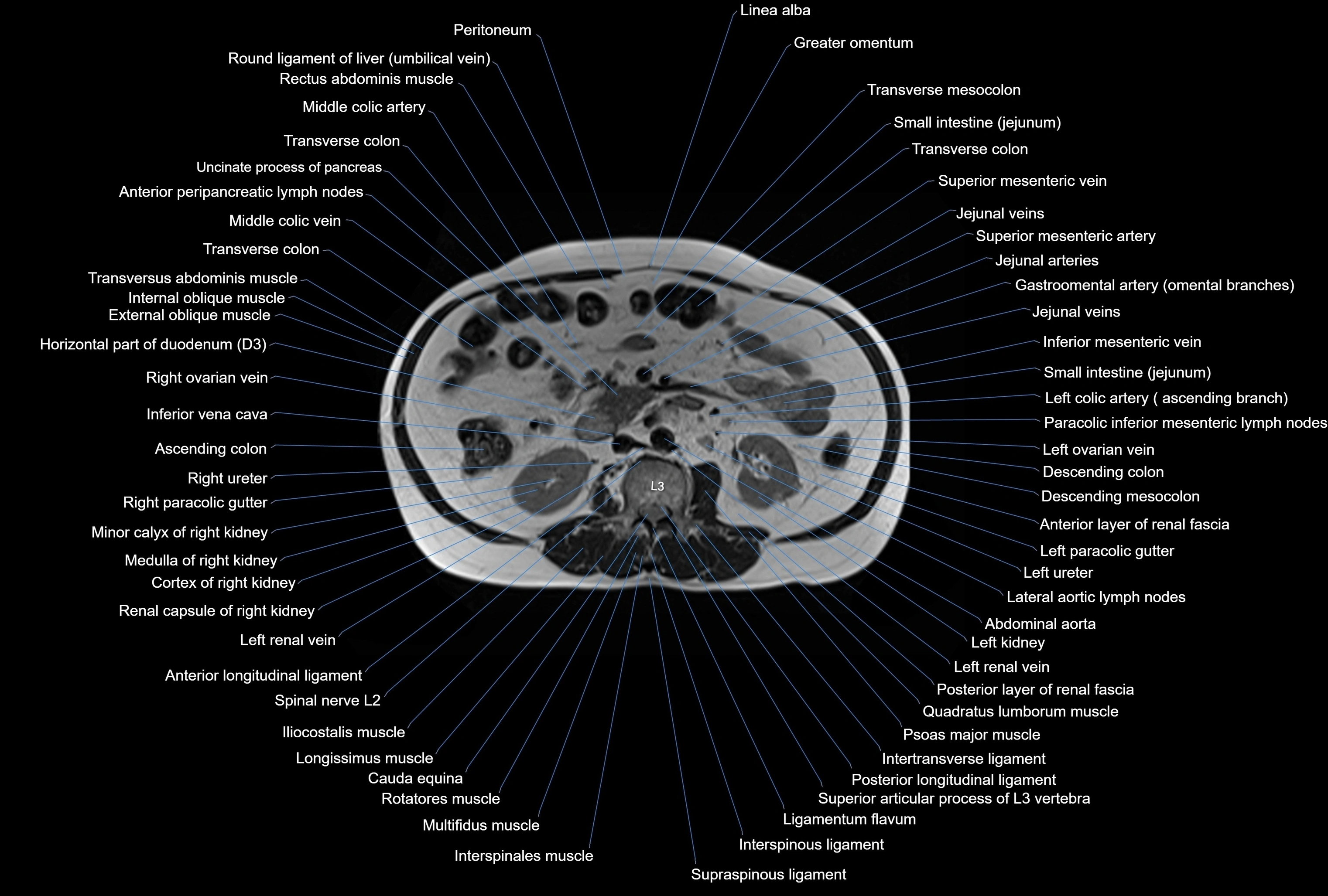MRI Abdomen axial cross sectional anatomy radiology  image-img-00001-00025.webp